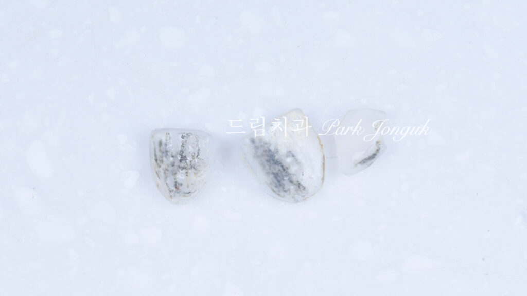 라미네이트 재시술, Laminate Revision, 라미네이트 재치료, Laminate Re-treatment, 자연스러운 라미네이트, Natural Laminate, 레이저 라미네이트 제거, Laser Laminate Removal, 과대 크기 교정, Oversized Correction