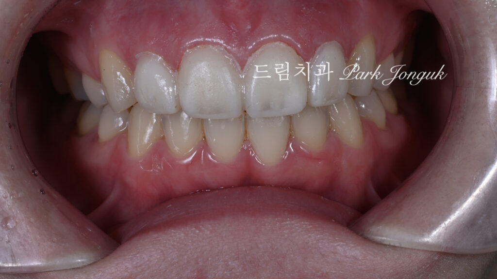 라미네이트 재시술, Laminate Revision, 라미네이트 재치료, Laminate Re-treatment, 자연스러운 라미네이트, Natural Laminate, 레이저 라미네이트 제거, Laser Laminate Removal, 과대 크기 교정, Oversized Correction