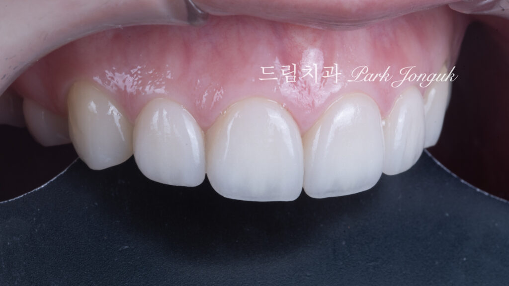 라미네이트 재시술, Laminate Revision, 라미네이트 재치료, Laminate Re-treatment, 자연스러운 라미네이트, Natural Laminate, 레이저 라미네이트 제거, Laser Laminate Removal, 과대 크기 교정, Oversized Correction