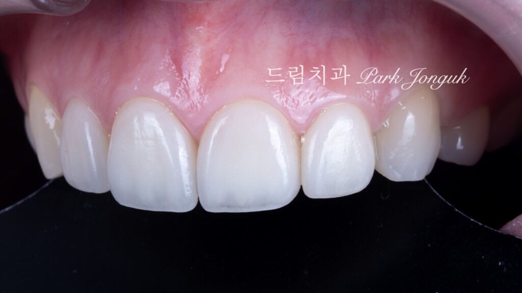 라미네이트 재시술, Laminate Revision, 라미네이트 재치료, Laminate Re-treatment, 자연스러운 라미네이트, Natural Laminate, 레이저 라미네이트 제거, Laser Laminate Removal, 과대 크기 교정, Oversized Correction