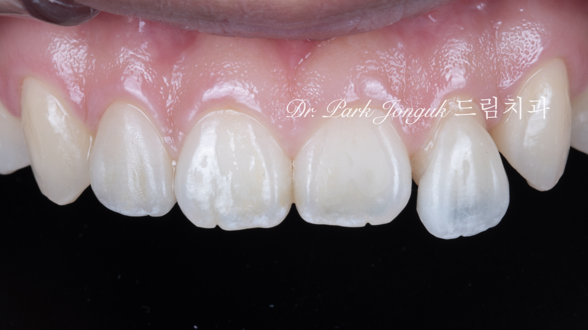 no-prep veneers, minimal prep veneers, porcelain veneers, biomimetic dentistry, cosmetic dentistry, aesthetic dentistry, non invasive dentistry, 무삭제 라미네이트, 라미네이트, 앞니 라미네이트, 벌어진 치아 라미네이트, 왜소치 라미네이트, diastema veneers, microdontia veneers, natural veneers, hand layered veneers, 강남 라미네이트