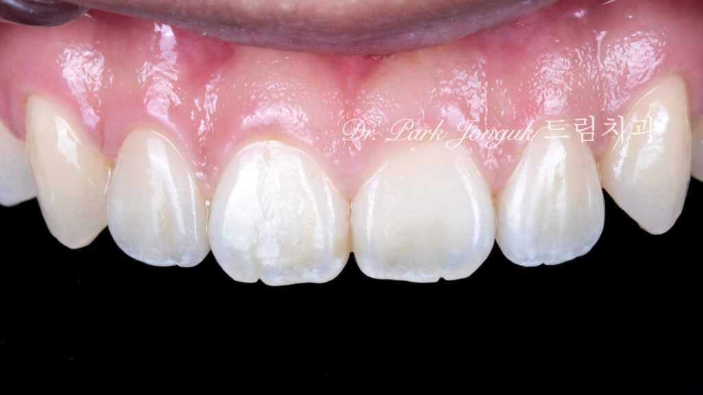 no-prep veneers, minimal prep veneers, porcelain veneers, biomimetic dentistry, cosmetic dentistry, aesthetic dentistry, non invasive dentistry, 무삭제 라미네이트, 라미네이트, 앞니 라미네이트, 벌어진 치아 라미네이트, 왜소치 라미네이트, diastema veneers, microdontia veneers, natural veneers, hand layered veneers, 강남 라미네이트