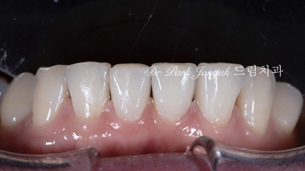 no-prep veneers, minimal prep veneers, porcelain veneers, biomimetic dentistry, cosmetic dentistry, aesthetic dentistry, non invasive dentistry, 무삭제 라미네이트, 라미네이트, 앞니 라미네이트, 벌어진 치아 라미네이트, 왜소치 라미네이트, diastema veneers, microdontia veneers, natural veneers, hand layered veneers, 강남 라미네이트