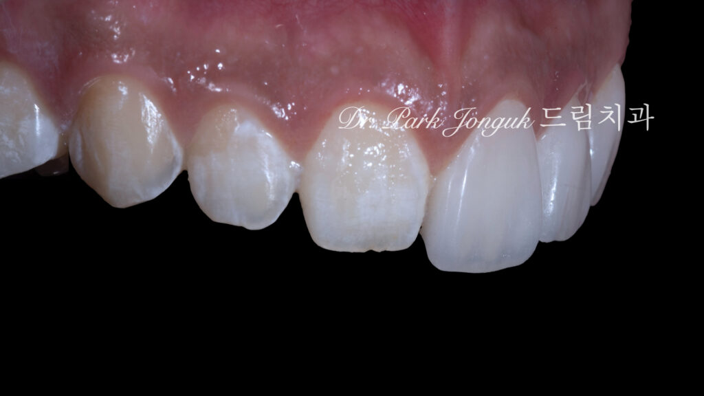 무삭제 라미네이트, No-Prep Laminate, 무삭제, No-Preparation, 치아 안 깎는 라미네이트, Non-Invasive Laminate, 옥니 라미네이트, Retroclined Teeth Laminate, 왜소치, Microdontia, 수작업 빌드업, Hand-Layered Build-up