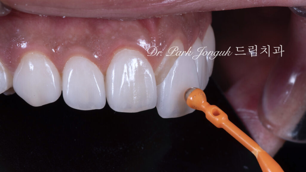 무삭제 라미네이트, No-Prep Laminate, 무삭제, No-Preparation, 치아 안 깎는 라미네이트, Non-Invasive Laminate, 옥니 라미네이트, Retroclined Teeth Laminate, 왜소치, Microdontia, 수작업 빌드업, Hand-Layered Build-up
