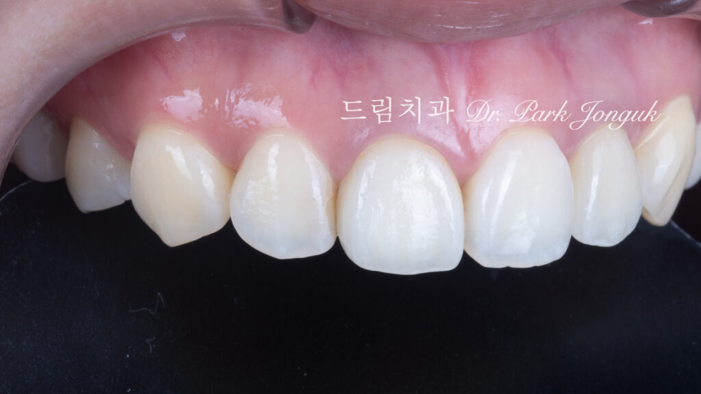 올세라믹 크라운 재시술, All-Ceramic Crown Revision, 라미네이트 재시술, Laminate Revision, 앞니 재치료, Anterior Revision, 실활치 미백, Internal Bleaching, 치은 착색, Gingival Discoloration, 지르코니아 크라운, Zirconia Crown