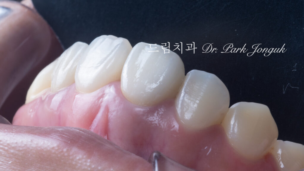 잇몸과 잘 어울리는 라미네이트