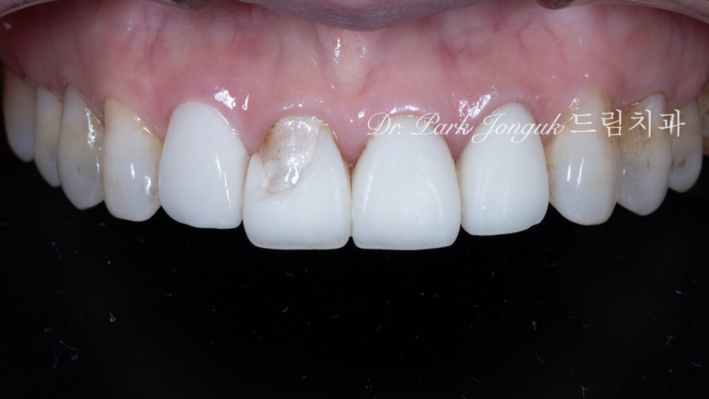 라미네이트 재시술, Laminate Revision, 과도한 치아 삭제, Excessive Tooth Preparation, 라미네이트 파절, Laminate Fracture, 상하악 통합 재건, Maxillo-Mandibular Reconstruction, 수작업 빌드업, Hand-Layered Build-up