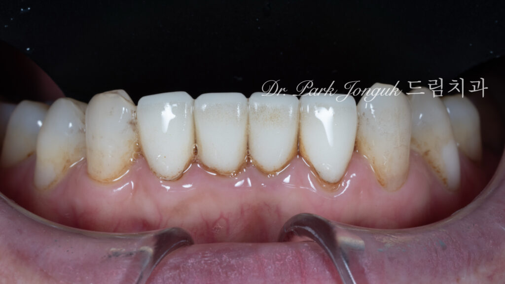 라미네이트 재시술, Laminate Revision, 과도한 치아 삭제, Excessive Tooth Preparation, 라미네이트 파절, Laminate Fracture, 상하악 통합 재건, Maxillo-Mandibular Reconstruction, 수작업 빌드업, Hand-Layered Build-up