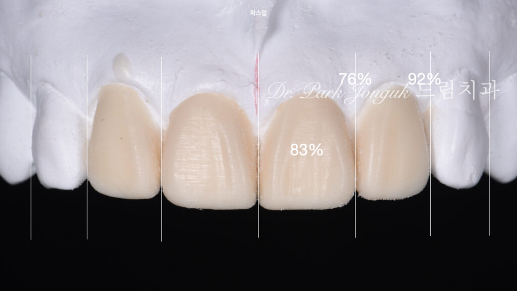 라미네이트 재시술, Laminate Revision, 과도한 치아 삭제, Excessive Tooth Preparation, 라미네이트 파절, Laminate Fracture, 상하악 통합 재건, Maxillo-Mandibular Reconstruction, 수작업 빌드업, Hand-Layered Build-up