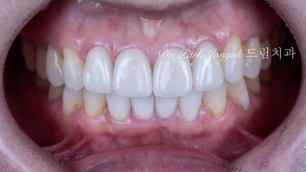 라미네이트 재시술, Laminate Revision, 과도한 치아 삭제, Excessive Tooth Preparation, 라미네이트 파절, Laminate Fracture, 상하악 통합 재건, Maxillo-Mandibular Reconstruction, 수작업 빌드업, Hand-Layered Build-up