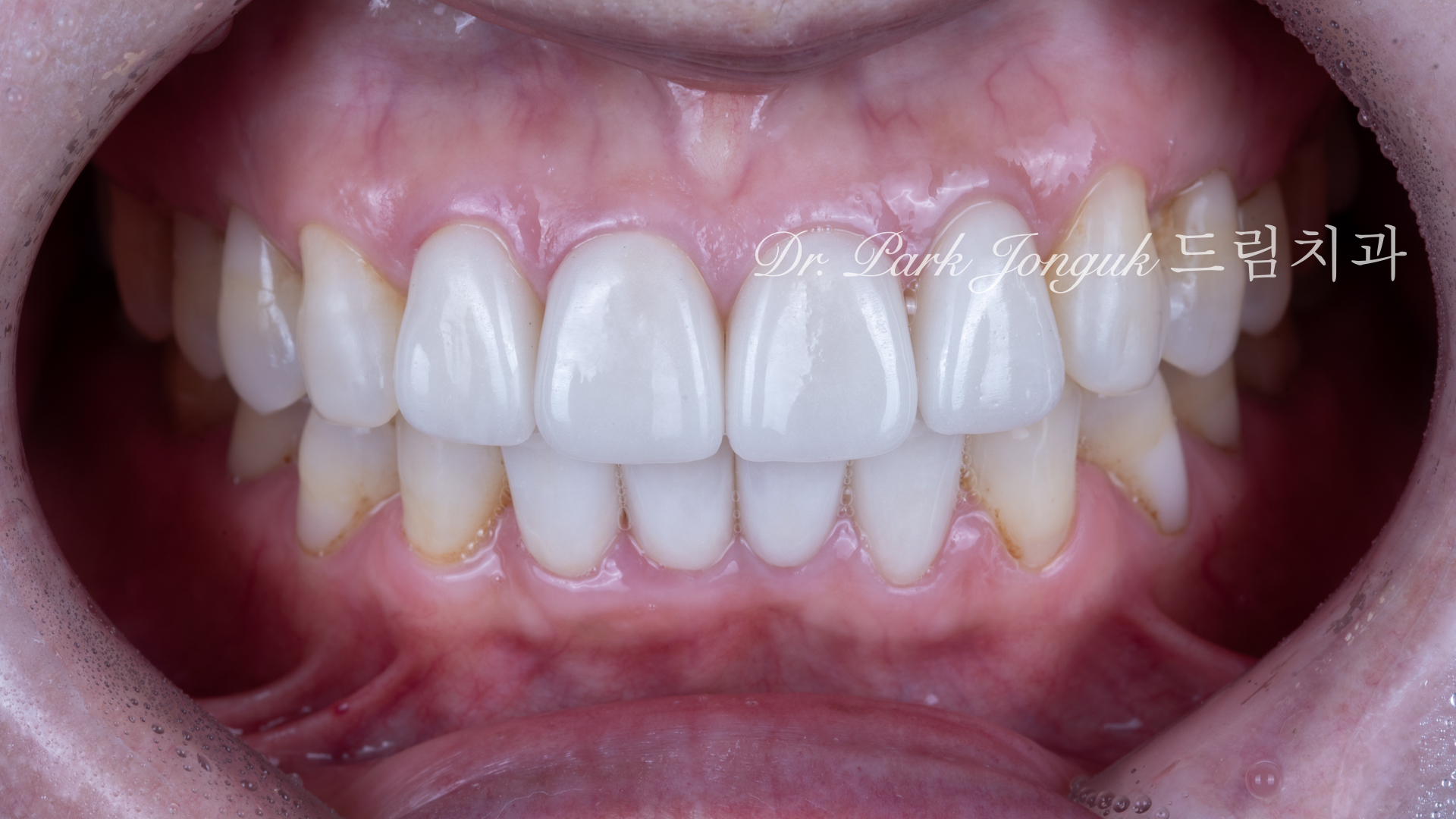 라미네이트 재시술, Laminate Revision, 과도한 치아 삭제, Excessive Tooth Preparation, 라미네이트 파절, Laminate Fracture, 상하악 통합 재건, Maxillo-Mandibular Reconstruction, 수작업 빌드업, Hand-Layered Build-up