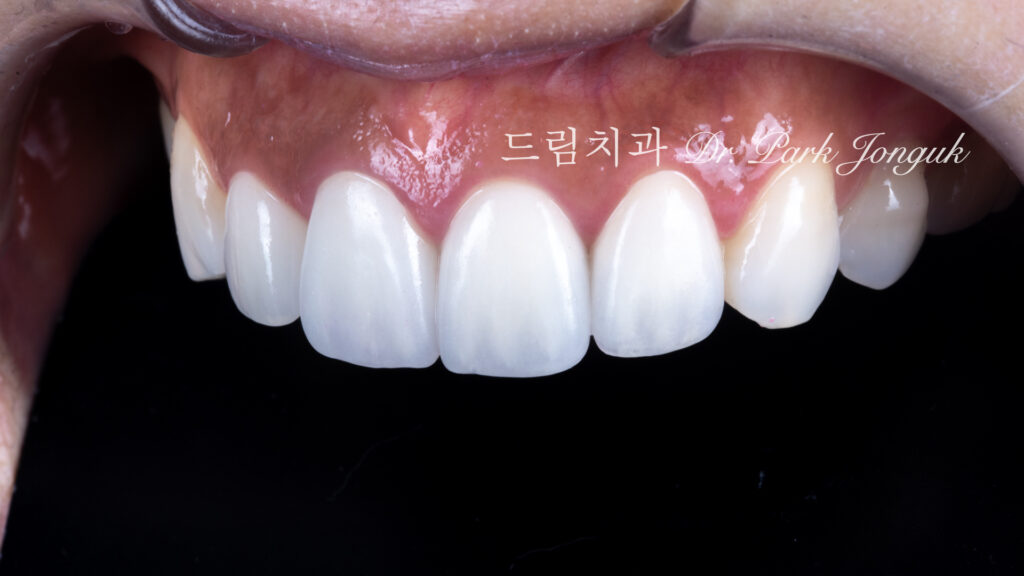 라미네이트 재시술, Laminate Revision, 올세라믹 크라운 재시술, All-Ceramic Crown Revision, 라미네이트 깨짐, Laminate Fracture, 신경 치료 후 변색, Post-Endodontic Discoloration