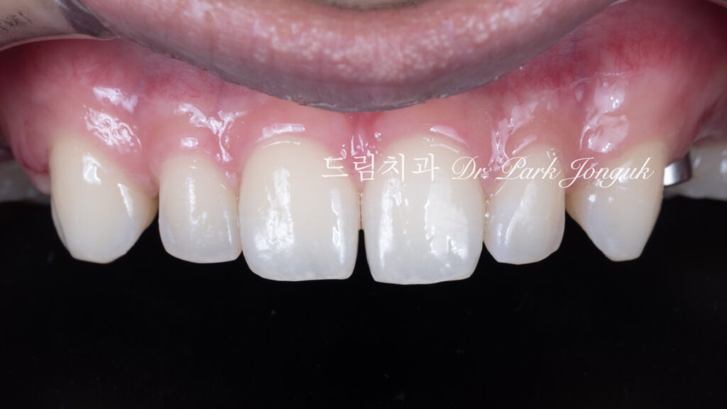 무삭제 라미네이트, No-Prep Laminate, 정밀 진단, Diagnostic Wax-up, 왁스업 진단, Diagnostic Wax-up, 비율 최적화, Proportion Optimization, 시각적 축소, Visual Reduction, 과대 치아, Oversized Teeth
