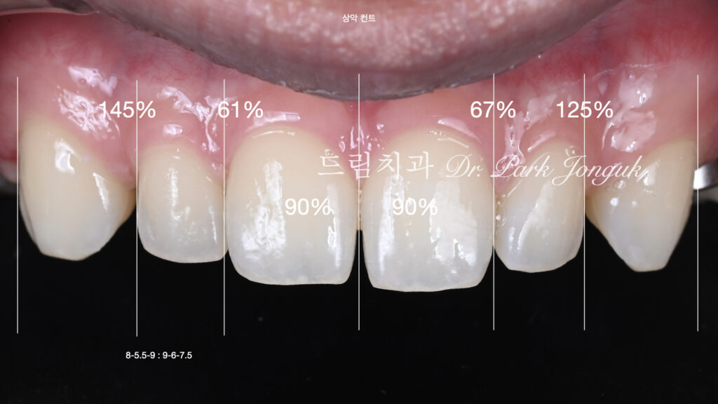 무삭제 라미네이트, No-Prep Laminate, 정밀 진단, Diagnostic Wax-up, 왁스업 진단, Diagnostic Wax-up, 비율 최적화, Proportion Optimization, 시각적 축소, Visual Reduction, 과대 치아, Oversized Teeth