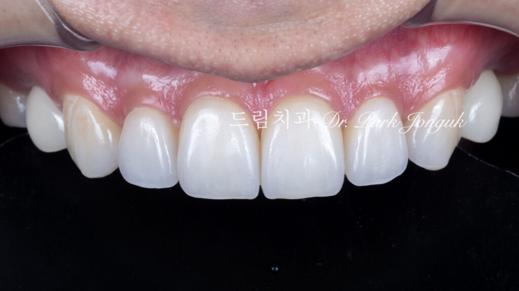 무삭제 라미네이트, No-Prep Laminate, 정밀 진단, Diagnostic Wax-up, 왁스업 진단, Diagnostic Wax-up, 비율 최적화, Proportion Optimization, 시각적 축소, Visual Reduction, 과대 치아, Oversized Teeth