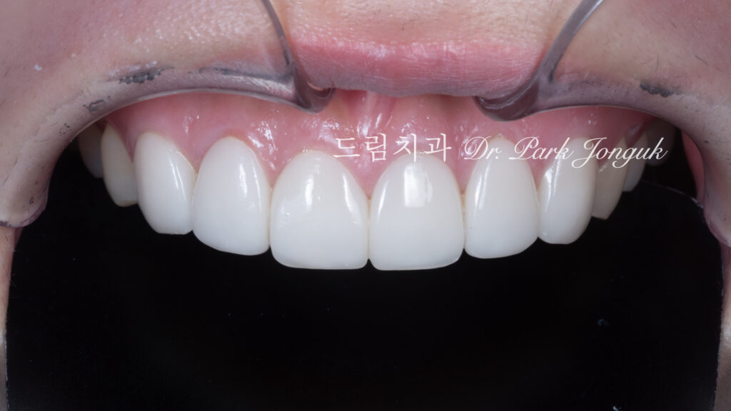라미네이트 재시술, Laminate Revision, 조기 재시술, Early Revision, 부분 재시술, Selective Revision, 레이저 제거, Laser Removal, 비율 최적화, Proportion Optimization