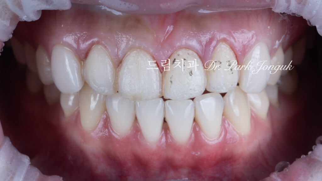 라미네이트 재시술, Laminate Revision, 조기 재시술, Early Revision, 부분 재시술, Selective Revision, 레이저 제거, Laser Removal, 비율 최적화, Proportion Optimization