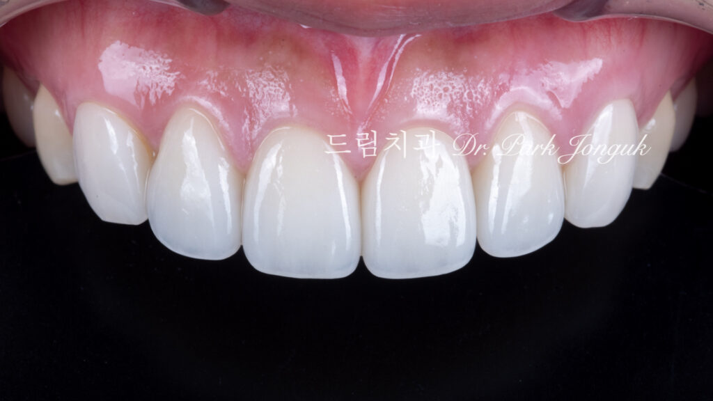 라미네이트 재시술, Laminate Revision, 조기 재시술, Early Revision, 부분 재시술, Selective Revision, 레이저 제거, Laser Removal, 비율 최적화, Proportion Optimization
