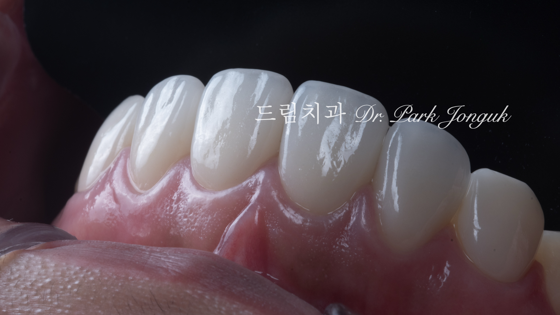 라미네이트 재시술, Laminate Revision, 조기 재시술, Early Revision, 부분 재시술, Selective Revision, 레이저 제거, Laser Removal, 비율 최적화, Proportion Optimization