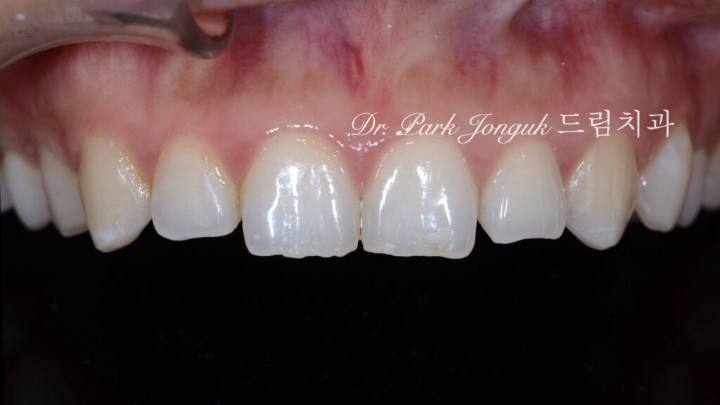 무삭제 라미네이트, No-Prep Laminate, 교정 후 라미네이트, Post-Orthodontic Laminate, 교정 후 옥니, Post-Orthodontic Retroclined Teeth, 옥니 라미네이트, Laminate for Retroclined Teeth, 다층 빌드업, Multi-Layered Build-up