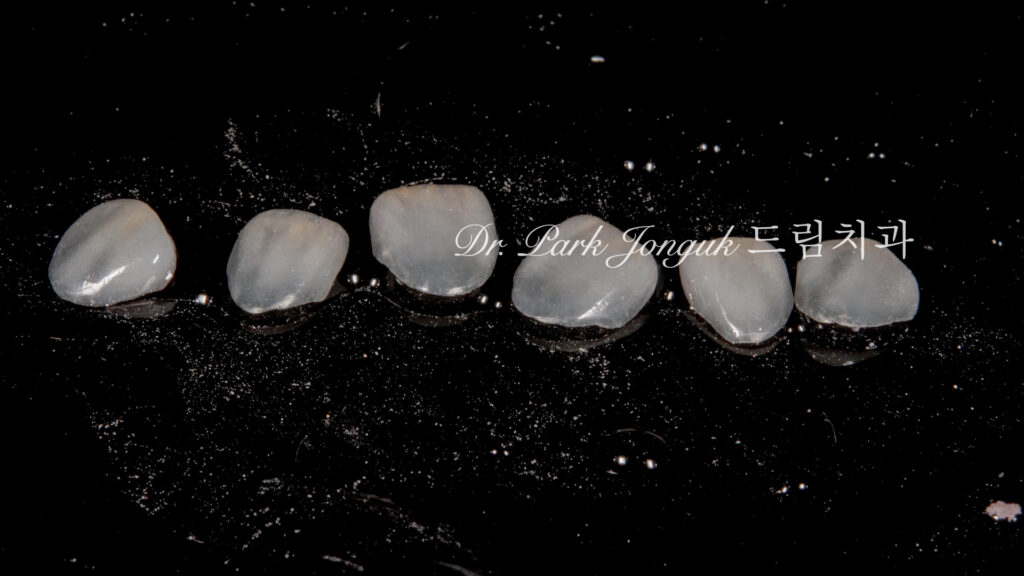 무삭제 라미네이트, No-Prep Laminate, 교정 후 라미네이트, Post-Orthodontic Laminate, 교정 후 옥니, Post-Orthodontic Retroclined Teeth, 옥니 라미네이트, Laminate for Retroclined Teeth, 다층 빌드업, Multi-Layered Build-up