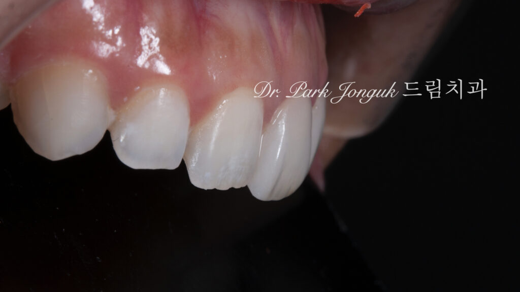 무삭제 라미네이트, No-Prep Laminate, 교정 후 라미네이트, Post-Orthodontic Laminate, 교정 후 옥니, Post-Orthodontic Retroclined Teeth, 옥니 라미네이트, Laminate for Retroclined Teeth, 다층 빌드업, Multi-Layered Build-up