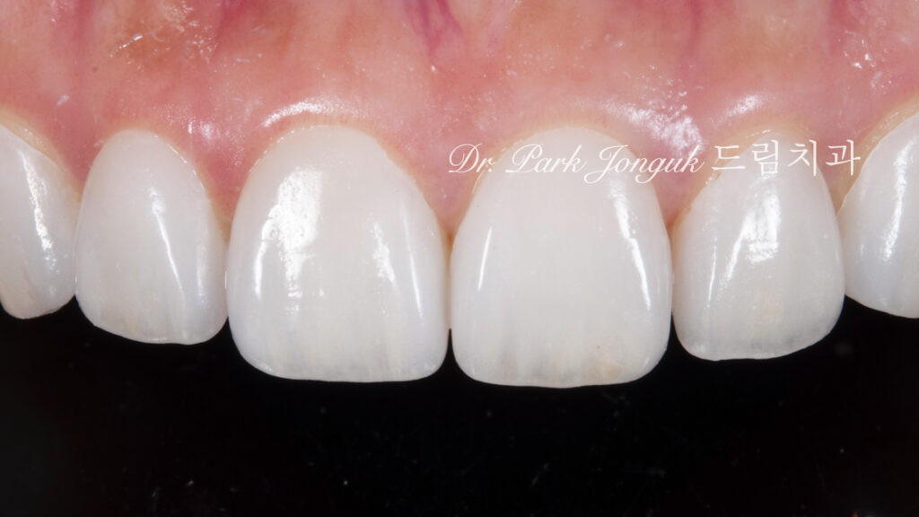 무삭제 라미네이트, No-Prep Laminate, 교정 후 라미네이트, Post-Orthodontic Laminate, 교정 후 옥니, Post-Orthodontic Retroclined Teeth, 옥니 라미네이트, Laminate for Retroclined Teeth, 다층 빌드업, Multi-Layered Build-up