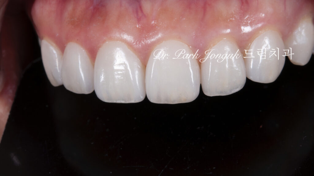 무삭제 라미네이트, No-Prep Laminate, 교정 후 라미네이트, Post-Orthodontic Laminate, 교정 후 옥니, Post-Orthodontic Retroclined Teeth, 옥니 라미네이트, Laminate for Retroclined Teeth, 다층 빌드업, Multi-Layered Build-up