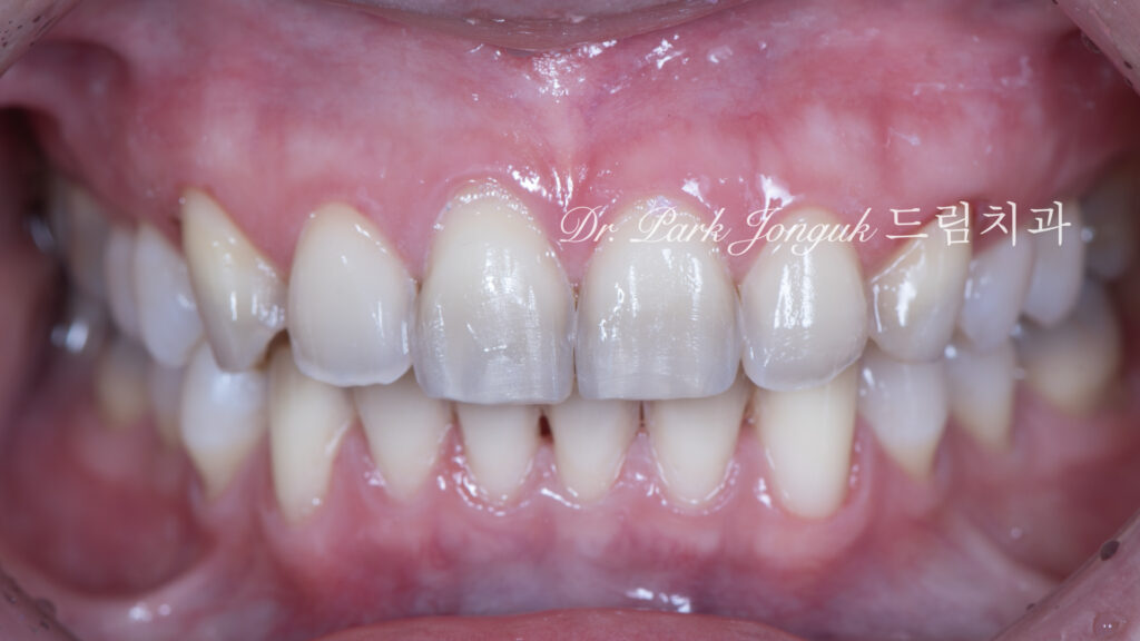 변색치아 라미네이트, Laminate for Discolored Teeth, 테트라사이클린 변색, Tetracycline Staining, 어두운 치아 라미네이트, Laminate for Dark Teeth, 항생제 변색, Antibiotic Staining, 내인성 변색, Intrinsic Discoloration, 변색 차폐, Discoloration Masking