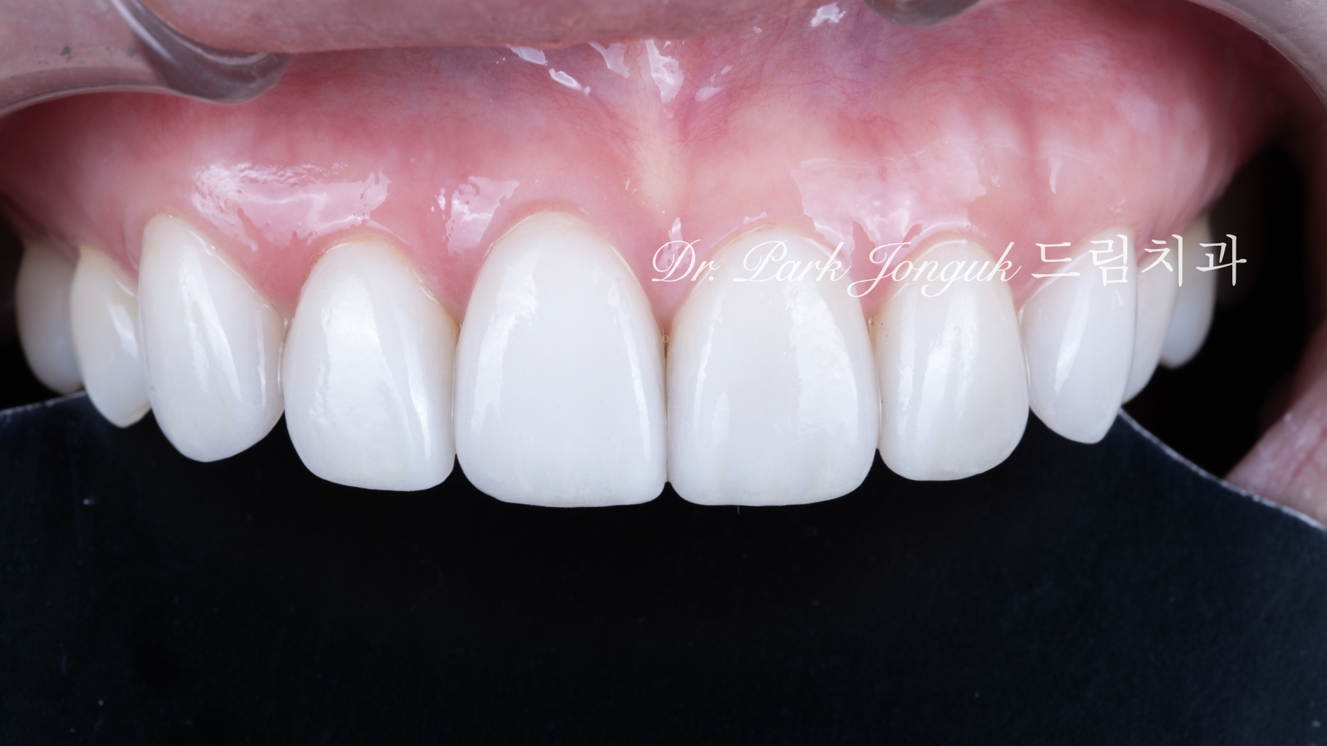 변색치아 라미네이트, Laminate for Discolored Teeth, 테트라사이클린 변색, Tetracycline Staining, 어두운 치아 라미네이트, Laminate for Dark Teeth, 항생제 변색, Antibiotic Staining, 내인성 변색, Intrinsic Discoloration, 변색 차폐, Discoloration Masking