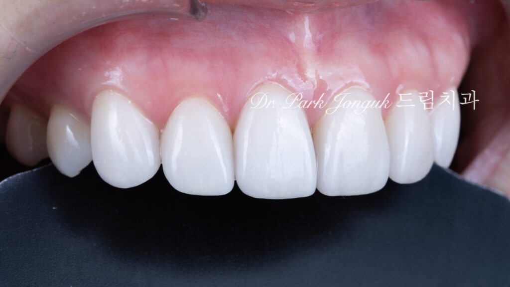 변색치아 라미네이트, Laminate for Discolored Teeth, 테트라사이클린 변색, Tetracycline Staining, 어두운 치아 라미네이트, Laminate for Dark Teeth, 항생제 변색, Antibiotic Staining, 내인성 변색, Intrinsic Discoloration, 변색 차폐, Discoloration Masking