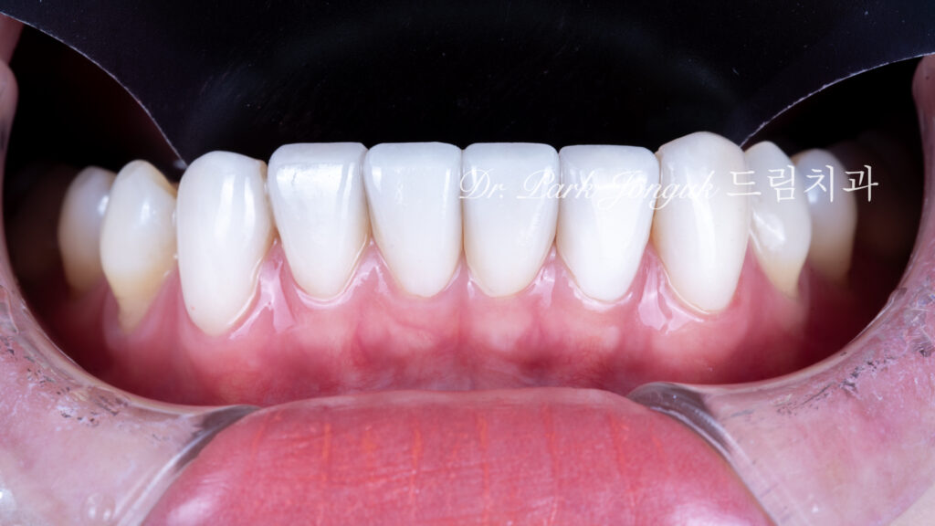변색치아 라미네이트, Laminate for Discolored Teeth, 테트라사이클린 변색, Tetracycline Staining, 어두운 치아 라미네이트, Laminate for Dark Teeth, 항생제 변색, Antibiotic Staining, 내인성 변색, Intrinsic Discoloration, 변색 차폐, Discoloration Masking