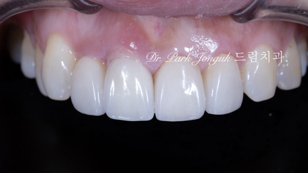 잇몸 라미네이트, Gingival Laminate, 핑크 라미네이트, Pink Laminate, 잇몸 재현, Gingival Reproduction, 핑크 포셀레인, Pink Porcelain, 치은 퇴축, Gingival Recession, 구순구개열, Cleft Lip and Palate