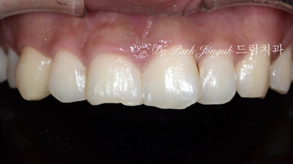앞니 라미네이트, Anterior Laminate, 강남 라미네이트, Gangnam Laminate, 라미네이트 잘하는 곳, Best Laminate Clinic, 치은 성형, Gingivectomy, 왁스업 진단, Diagnostic Wax-up, 수작업 빌드업, Hand-Layered Build-up