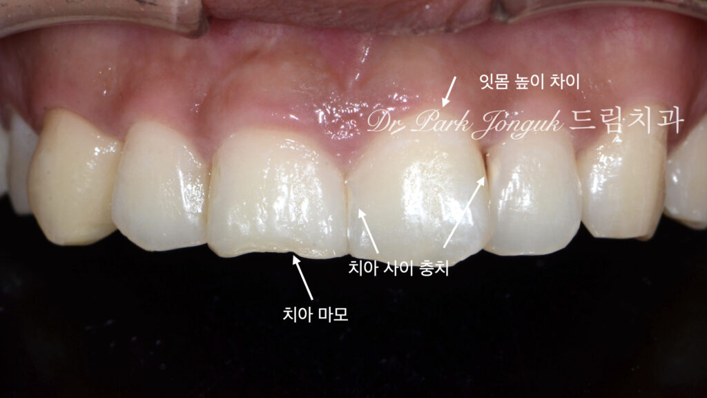 앞니 라미네이트, Anterior Laminate, 강남 라미네이트, Gangnam Laminate, 라미네이트 잘하는 곳, Best Laminate Clinic, 치은 성형, Gingivectomy, 왁스업 진단, Diagnostic Wax-up, 수작업 빌드업, Hand-Layered Build-up