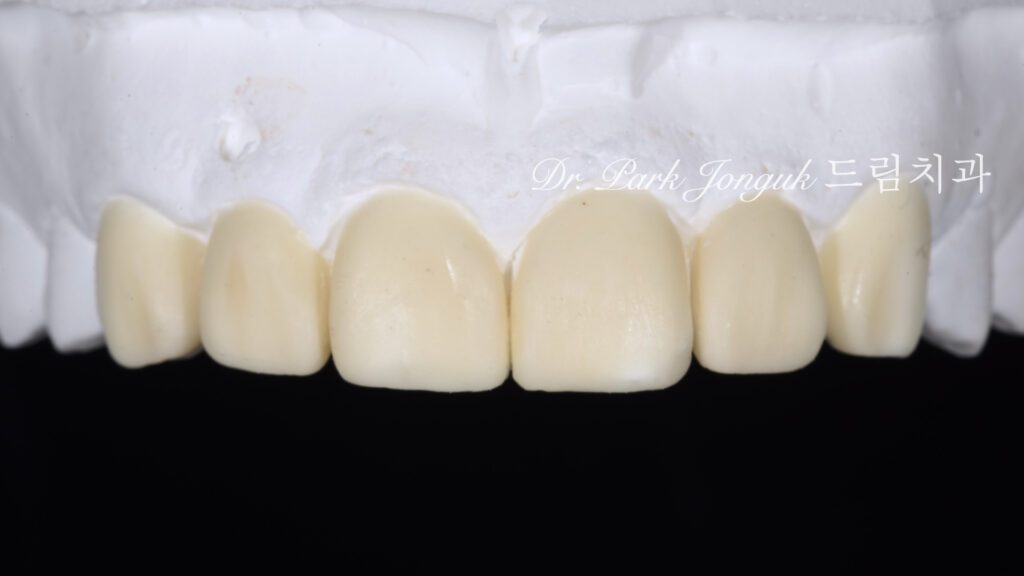 앞니 라미네이트, Anterior Laminate, 강남 라미네이트, Gangnam Laminate, 라미네이트 잘하는 곳, Best Laminate Clinic, 치은 성형, Gingivectomy, 왁스업 진단, Diagnostic Wax-up, 수작업 빌드업, Hand-Layered Build-up