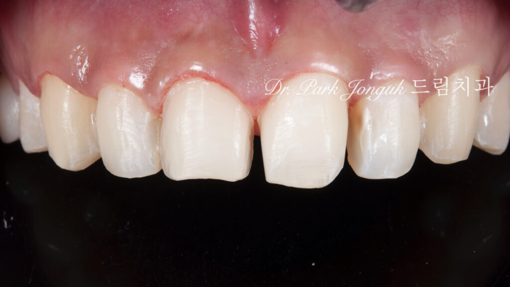 앞니 라미네이트, Anterior Laminate, 강남 라미네이트, Gangnam Laminate, 라미네이트 잘하는 곳, Best Laminate Clinic, 치은 성형, Gingivectomy, 왁스업 진단, Diagnostic Wax-up, 수작업 빌드업, Hand-Layered Build-up