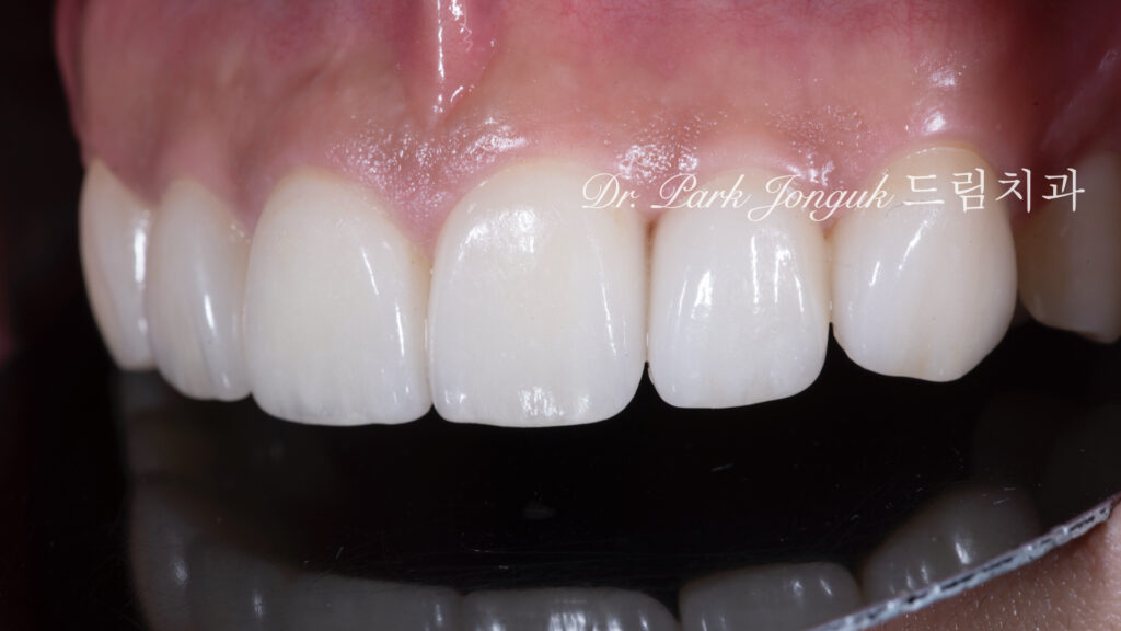 앞니 라미네이트, Anterior Laminate, 강남 라미네이트, Gangnam Laminate, 라미네이트 잘하는 곳, Best Laminate Clinic, 치은 성형, Gingivectomy, 왁스업 진단, Diagnostic Wax-up, 수작업 빌드업, Hand-Layered Build-up