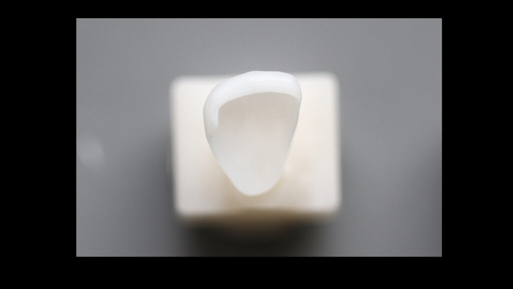 앞니 라미네이트, Anterior Laminate, 라미네이트 잘하는 곳, Best Laminate Clinic, 라미네이트 종류, Types of Laminate, 라미네이트 제작 과정, Laminate Fabrication Process, 핸드메이드 빌드업, Hand-Layered Build-up, 원데이 라미네이트, One-Day Laminate