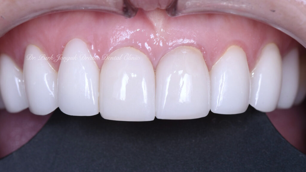 앞니 라미네이트, Anterior Laminate, 라미네이트 잘하는 곳, Best Laminate Clinic, 라미네이트 종류, Types of Laminate, 라미네이트 제작 과정, Laminate Fabrication Process, 핸드메이드 빌드업, Hand-Layered Build-up, 원데이 라미네이트, One-Day Laminate