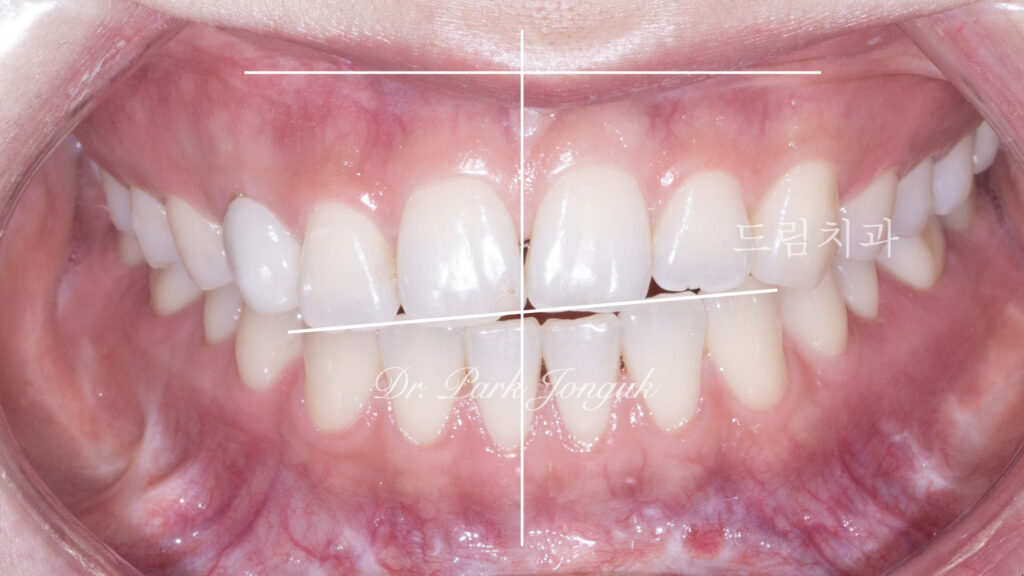 교정 후 라미네이트, Post-Orthodontic Laminate, 치아 축 기울기, Tooth Axis Inclination, 비대칭 교합 평면, Asymmetric Occlusal Plane, 교정 후 불만족, Post-Orthodontic Dissatisfaction, 치아 형태 보정, Tooth Morphology Correction