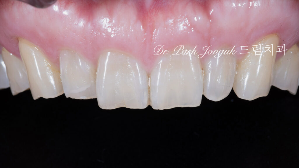 50대 라미네이트, 60대 라미네이트, 중장년층 라미네이트, 치아 누렇게, 법랑질 손실, Enamel Loss, 치아 마모, Tooth Wear, 법랑질 보충, Enamel Replacement, 리튬 디실리케이트, Lithium Disilicate