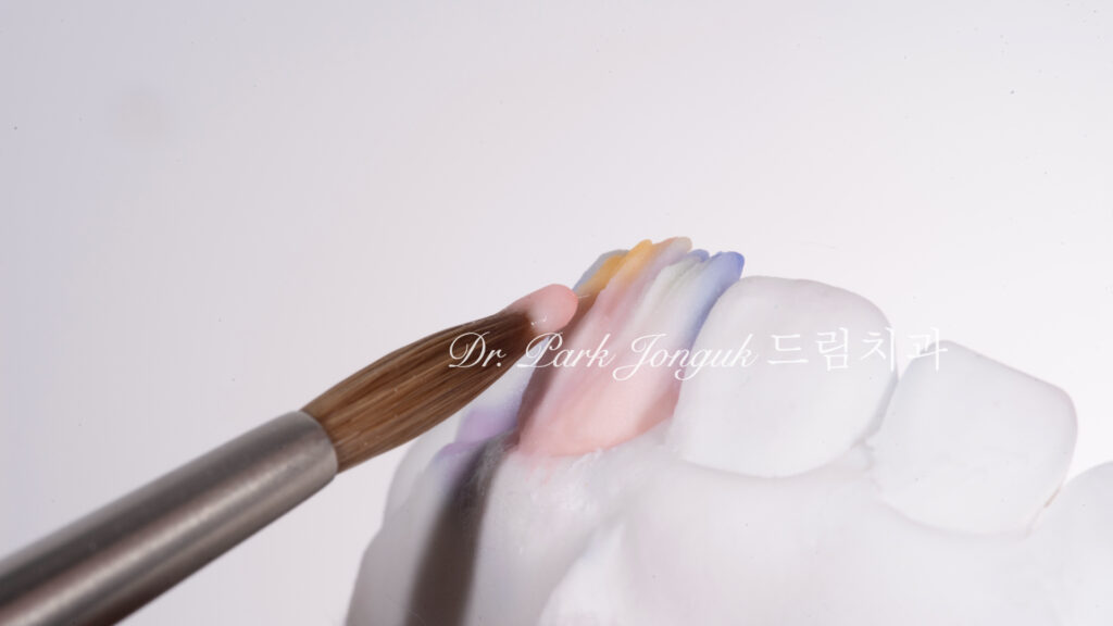 50대 라미네이트, 60대 라미네이트, 중장년층 라미네이트, 치아 누렇게, 법랑질 손실, Enamel Loss, 치아 마모, Tooth Wear, 법랑질 보충, Enamel Replacement, 리튬 디실리케이트, Lithium Disilicate