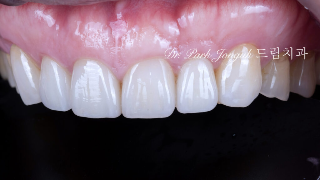 50대 라미네이트, 60대 라미네이트, 중장년층 라미네이트, 치아 누렇게, 법랑질 손실, Enamel Loss, 치아 마모, Tooth Wear, 법랑질 보충, Enamel Replacement, 리튬 디실리케이트, Lithium Disilicate