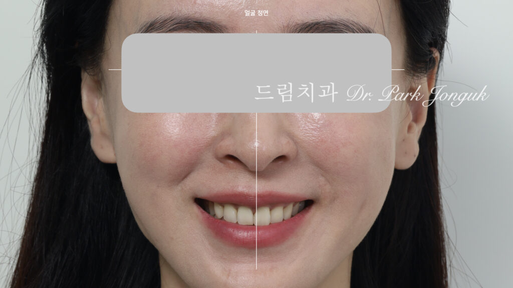 라미네이트 진단, Laminate Diagnosis, 정밀 진단, Precise Diagnosis, 얼굴 분석, Facial Analysis, 치아 비율, Tooth Proportion, 디지털 분석, Digital Analysis, 치료 예측, Treatment Prediction
