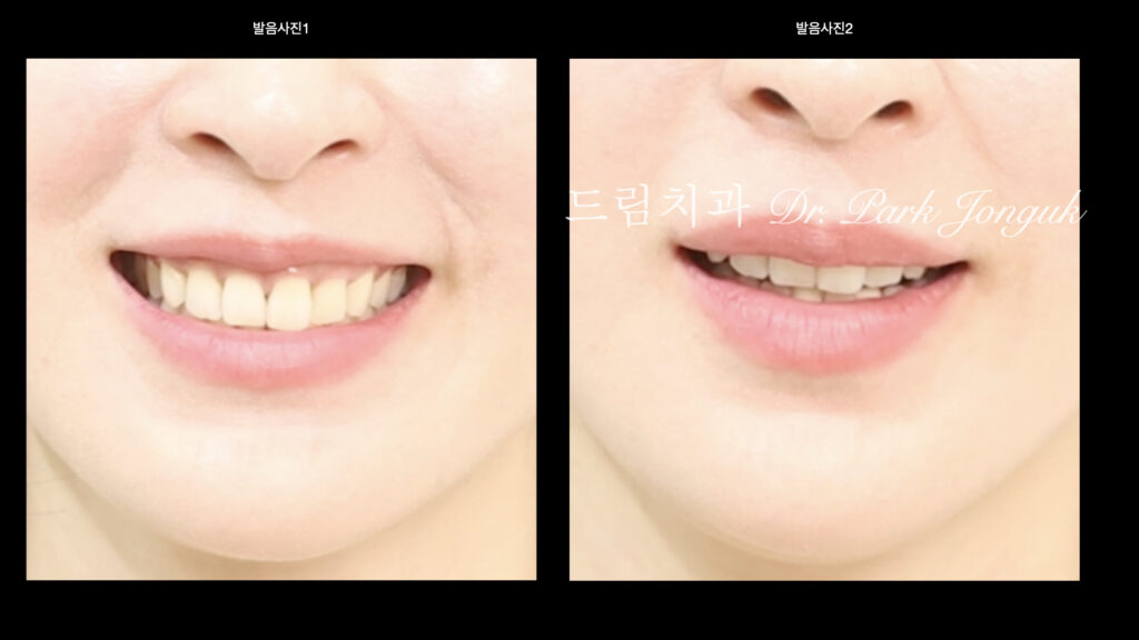 라미네이트 진단, Laminate Diagnosis, 정밀 진단, Precise Diagnosis, 얼굴 분석, Facial Analysis, 치아 비율, Tooth Proportion, 디지털 분석, Digital Analysis, 치료 예측, Treatment Prediction
