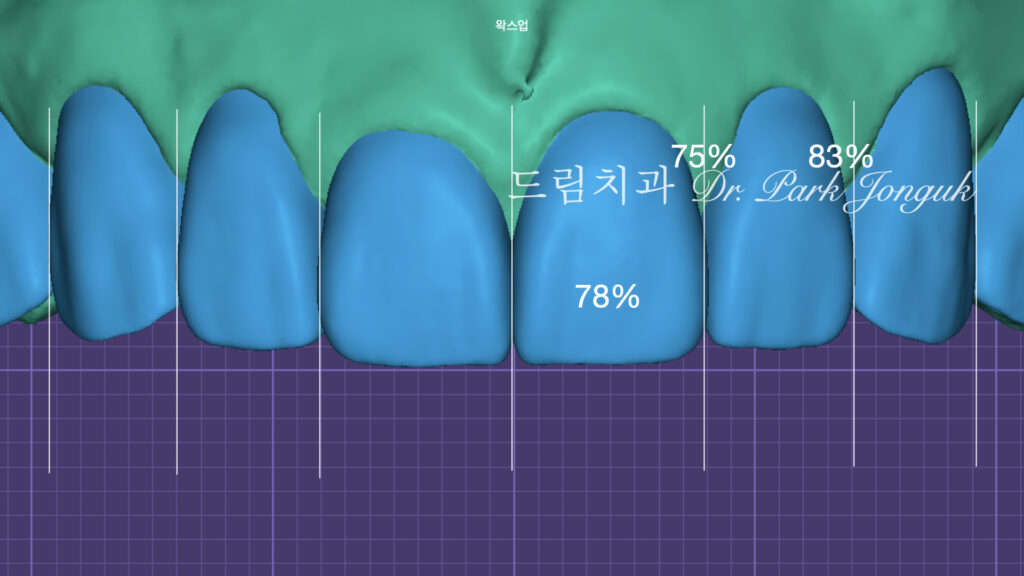라미네이트 진단, Laminate Diagnosis, 정밀 진단, Precise Diagnosis, 얼굴 분석, Facial Analysis, 치아 비율, Tooth Proportion, 디지털 분석, Digital Analysis, 치료 예측, Treatment Prediction
