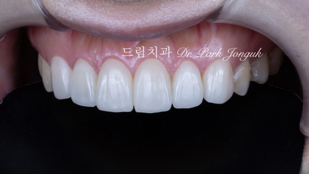 교정 후 라미네이트, Post-Orthodontic Laminate, 무삭제 라미네이트, No-Prep Laminate, 화이트스팟, White Spot Lesions, 초기 우식, Incipient Caries, 표면 질감, Surface Texture