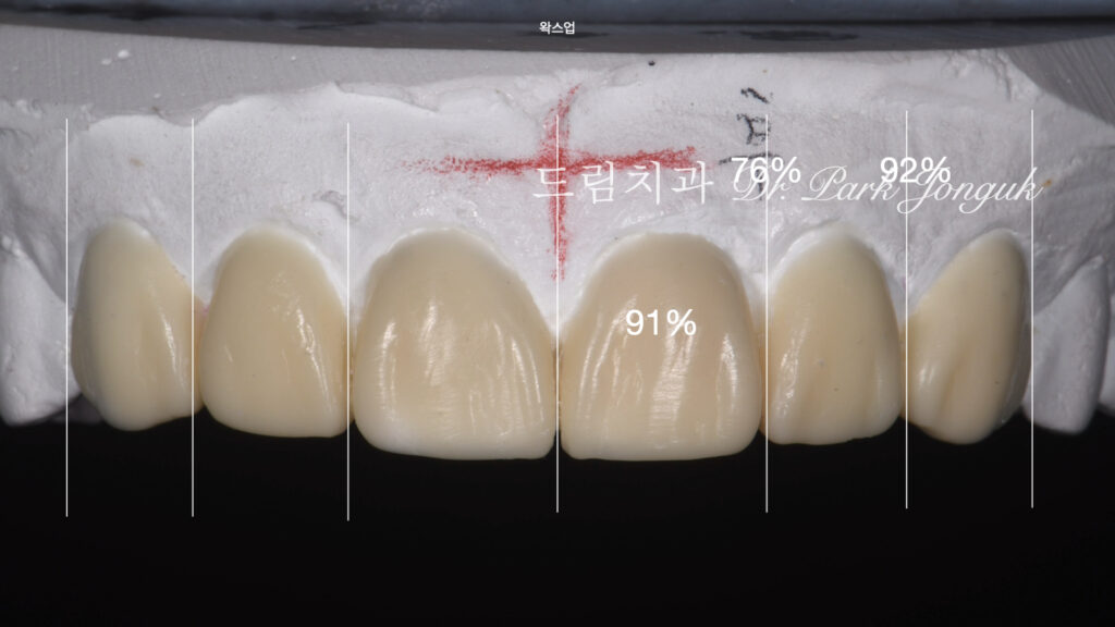 올세라믹 크라운 재시술, All-Ceramic Crown Remake, 무삭제 라미네이트, No-Prep Laminate, 왜소치, Peg-Shaped Lateral Incisors, 라미네이트 재시술, Laminate Remake, 측절치 크라운, Lateral Incisor Crown